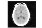 腦栓塞 I66.903 栓塞性腦梗死