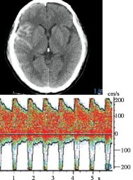 顱腦損傷 顱腦外傷 Head injury