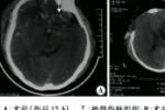 顱腦損傷 顱腦外傷 Head injury