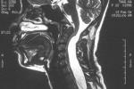 脊髓神經鞘瘤 D32.151 脊髓神經纖維瘤 脊髓許旺氏細胞瘤