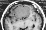 腦膜肉瘤 C70.053 