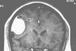 腦膜肉瘤 C70.053 