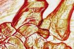 扭轉痙攣 G24.101 