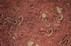 腦血吸蟲病 B65.952 