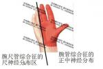 腕尺管綜合征