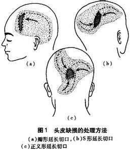 頭皮損傷