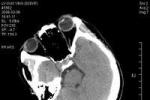 原發性腦幹損傷 Primary　brain　stem　injury