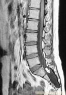 硬脊膜下膿腫