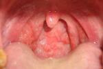 白喉 diphtheria