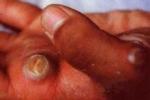 羊痘 傳染性膿皰性皮病 傳染性深膿皰疹 感染性唇部皮炎