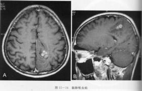 肺吸蟲病 B66.402+ 並殖吸蟲病 肺蛭病