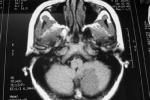 散發性腦炎 G04.919 