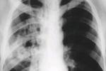 老年肺結核 老年人肺結核病 senile pulmonary tuberculosis