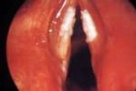 咽結合膜熱 小兒咽結合膜熱