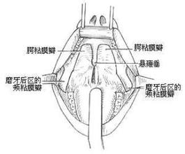 咽部麻風