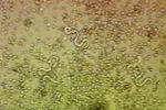 盤尾絲蟲病 B73.X53+ 河盲癥 旋盤尾線蟲病 致盲絲蟲病