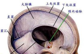 硬腦膜下積膿癥