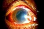 電光性眼炎 H16.101 雪盲 紫外線傷