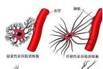 丙烯酰胺中毒