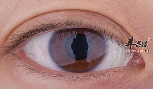 導致我們眼睛浮腫的原因有哪些