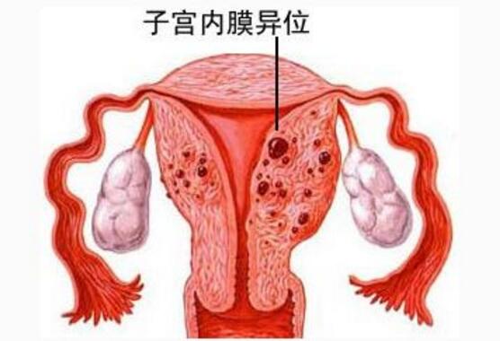 子宮移位是怎麼回事