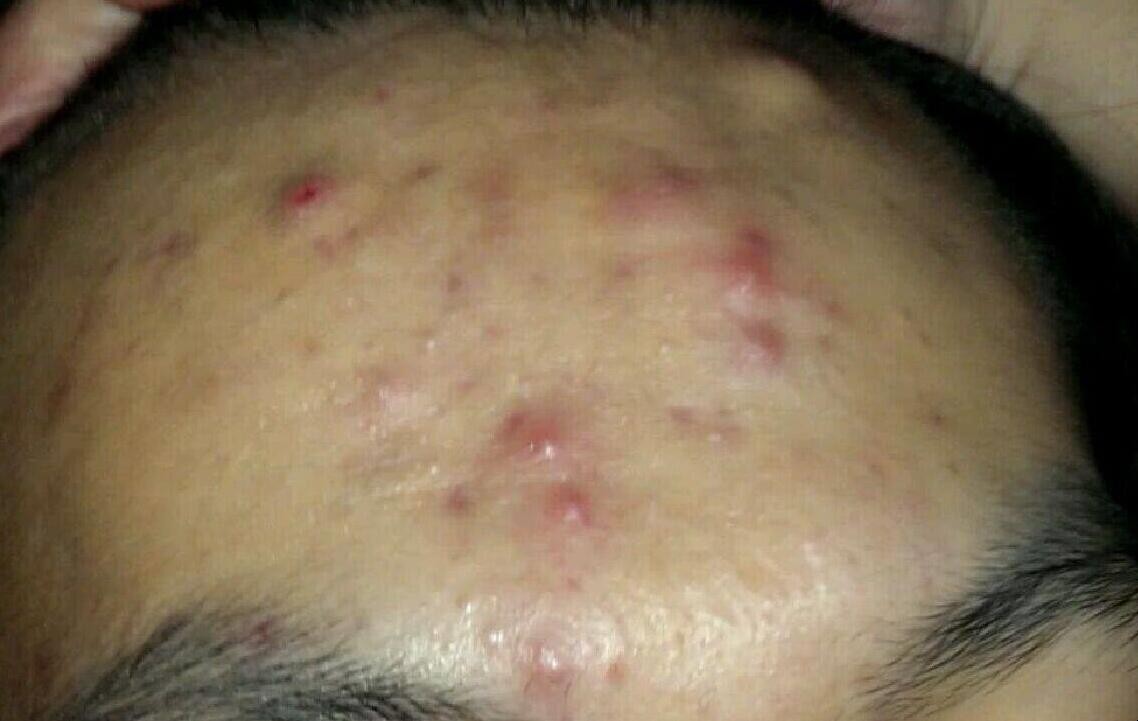 額頭上長痘痘怎麼辦