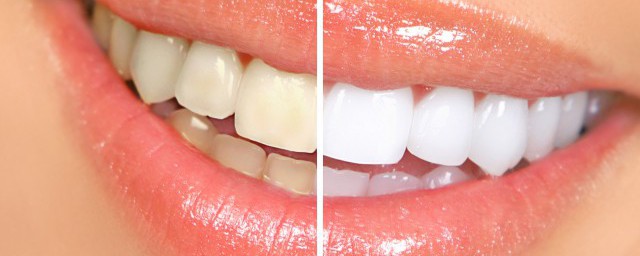 牙黃怎麼變白 怎麼讓牙齒變白