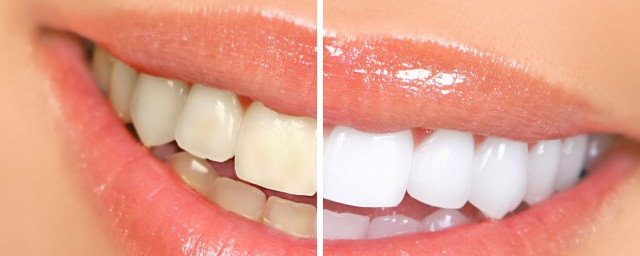 黃牙怎麼變白牙 黃牙變白的方法