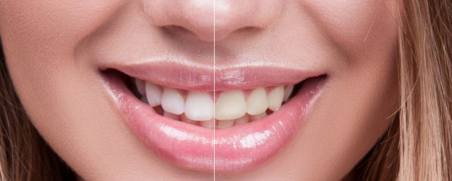 牙齒黃正確解決方法 牙齒黃怎麼辦