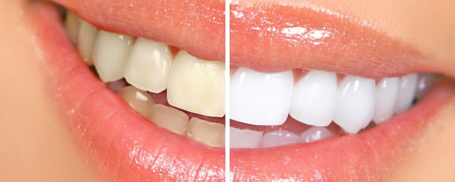 牙齒黃怎麼變白 用什麼刷牙好呢