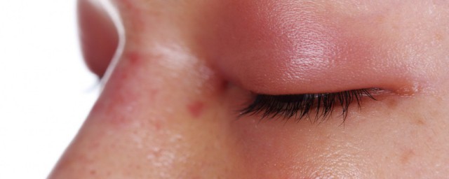 眼睛腫是什麼原因 眼睛浮腫原因分析