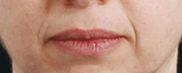 嘴周圍有皺紋怎麼辦 嘴周圍有皺紋的解決方法