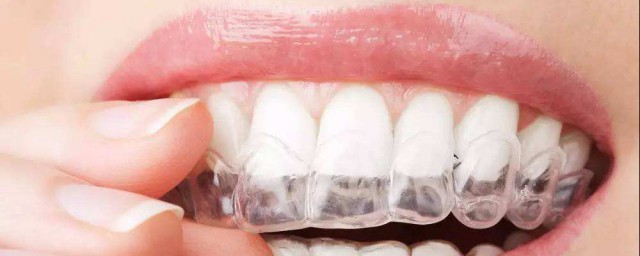牙套適合年齡 具體是適合什麼年齡