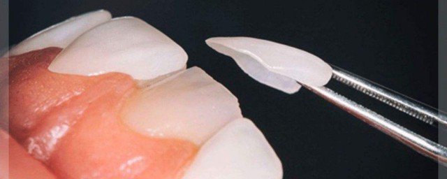 美白牙齒最有效的方法 有什麼改善的技巧