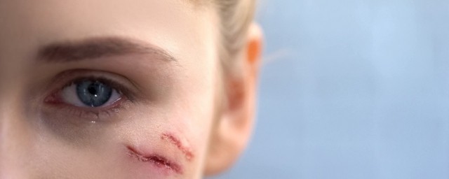 怎麼樣消除臉上的疤 外敷內服科學祛疤痕方法介紹