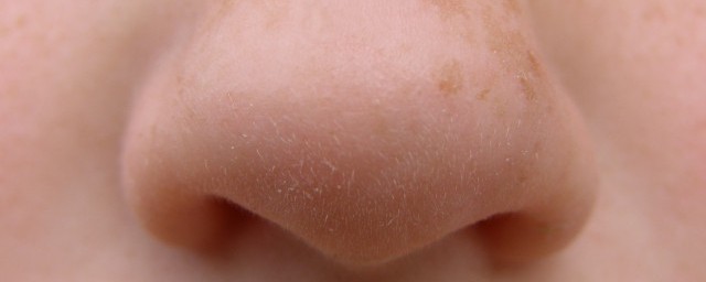 閉口粉刺是怎麼形成的 閉口粉刺的形成原因
