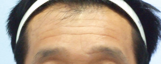 額頭皺紋怎麼去除 去除額頭皺紋的方法