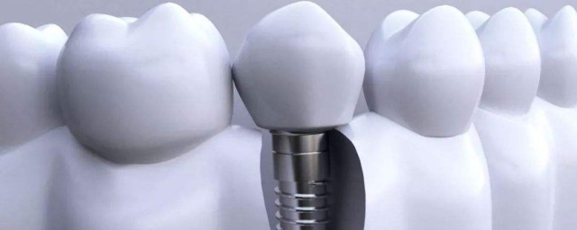 種牙後註意事項有哪些 種植牙齒簡介