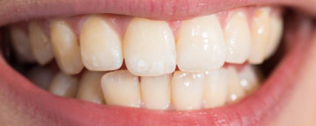 牙石是什麼 關於牙石的簡介