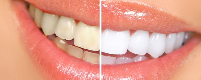 洗牙牙縫會變寬嗎 為什麼牙縫洗過牙之後會變寬?