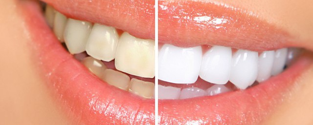 怎麼樣才能讓牙齒變白 能讓牙齒變白的方法