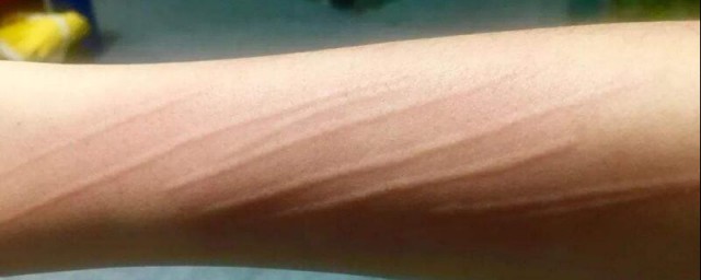 疤痕皮膚怎麼修復 疤痕皮膚修復的方法