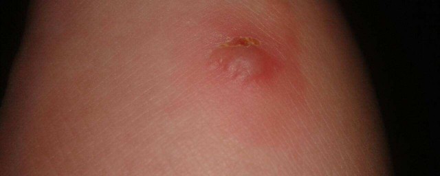 蚊蟲叮咬紅腫癢怎麼辦 蚊蟲叮咬紅腫癢處理