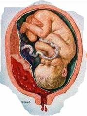 胎盤早剝 胎盤的過早分離 胎盤早期剝離 胎盤早期脫離