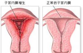 子宮內膜厚 子宮內膜增厚