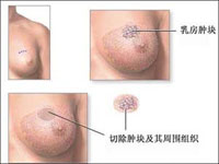 乳腺腫瘤 Breast cancer