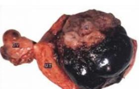 侵蝕性葡萄胎 Erosion sex hydatidiform mole