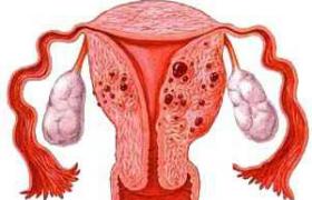 子宮腺肌病 N85.856 子宮內子宮內膜異位癥