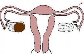 排卵障礙 不排卵