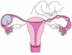 輸卵管妊娠 O00.101 異位妊娠 宮外孕